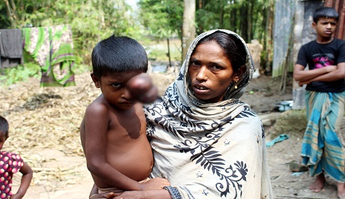 বিরল রোগে আক্রান্ত তাহমিনা বাঁচতে চায়