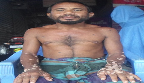 সারা শরীরের বিরল প্রকৃতির আঁচিল নিয়ে বিপাকে যুবক