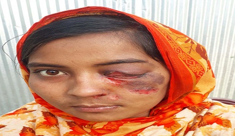 টাকার অভাবে চোখ হারাতে বসেছেন রংপুরের গৃহবধূ