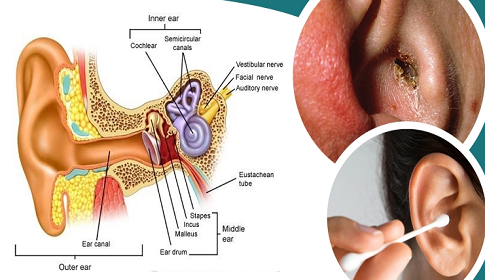 কটনবাড দিয়ে কান পরিষ্কার করলে কী হয়?