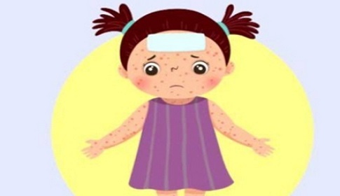 ফরিদপুরে ২৪ ঘণ্টায় ১৫ জনের হামের উপসর্গ 