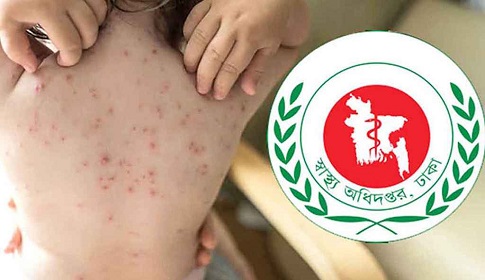 হামের উপসর্গ নিয়ে আরও ৩ শিশুর মৃত্যু