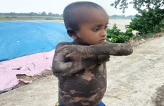 বিরল রোগে আক্রান্ত শিশু আকাশ