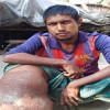 নগরকান্দায় ফাইলেরিয়া রোগে ভুগছেন বোরহান, মানবিক  সহায়তার দাবি