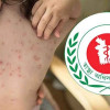 <p>হামের উপসর্গ নিয়ে আরও ৩ শিশুর মৃত্যু</p>