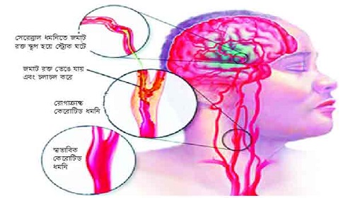 স্ট্রোকের চিকিৎসায় হোমিওপ্যাথি