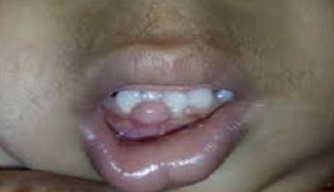 দাঁতের মাড়ির অস্বাভাবিক মাংস বৃদ্ধিতে হোমিওপ্যাথির ভূমিকা