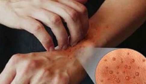 কুষ্ঠ চিকিৎসা: লজ্জা নয়, সাহস প্রয়োজন