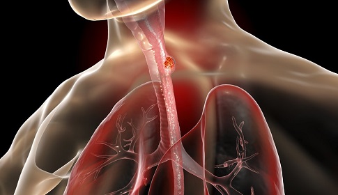 পেট ও খাদ্যনালীর ক্যান্সার চিকিৎসায় হোমিও সমাধান 