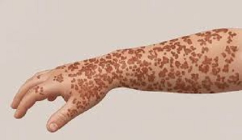 নারায়ণগঞ্জের ‘হাম’ পরিস্থিতি বেশ ভালো, রয়েছে পর্যাপ্ত টিকা