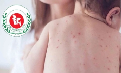 হাম উপসর্গে প্রাণ গেলো আরও ৬ শিশুর