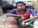 নগরকান্দায় ফাইলেরিয়া রোগে ভুগছেন বোরহান, মানবিক  সহায়তার দাবি