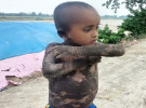 বিরল রোগে আক্রান্ত শিশু আকাশ