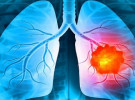 ফুসফুস ক্যান্সারের চিকিৎসায় হোমিওপ্যাথি  