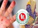 হামের উপসর্গে ১৬ জনের মৃত্যু
