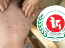 হামের উপসর্গ নিয়ে আরও ৩ শিশুর মৃত্যু