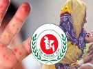 হাম ও উপসর্গ নিয়ে আরও ৫ শিশুর মৃত্যু