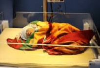 অপরিণত নবজাতকের জীবন রক্ষায় হোমিওপ্যাথি 