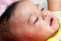 মুন্সীগঞ্জে হামের প্রকোপ বৃদ্ধি, ১১ জনের শরীরে শনাক্ত