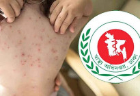 হামের উপসর্গ নিয়ে আরও ৩ শিশুর মৃত্যু