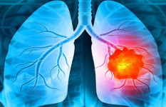 ফুসফুস ক্যান্সারের চিকিৎসায় হোমিওপ্যাথি  