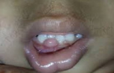 দাঁতের মাড়ির অস্বাভাবিক মাংস বৃদ্ধিতে হোমিওপ্যাথির ভূমিকা