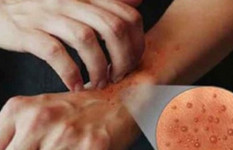 কুষ্ঠ চিকিৎসা: লজ্জা নয়, সাহস প্রয়োজন