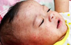 মুন্সীগঞ্জে হামের প্রকোপ বৃদ্ধি, ১১ জনের শরীরে শনাক্ত