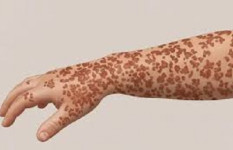 নারায়ণগঞ্জের ‘হাম’ পরিস্থিতি বেশ ভালো, রয়েছে পর্যাপ্ত টিকা