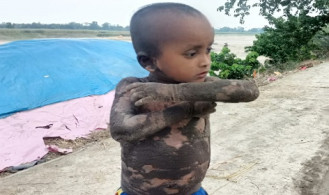 বিরল রোগে আক্রান্ত শিশু আকাশ