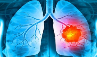 ফুসফুস ক্যান্সারের চিকিৎসায় হোমিওপ্যাথি  