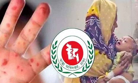 হাম ও উপসর্গ নিয়ে আরও ৫ শিশুর মৃত্যু